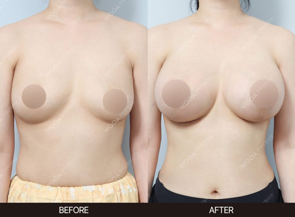 Breast Augmentation before and after – Case 25 – WOOA Plastic Surgery Gangnam