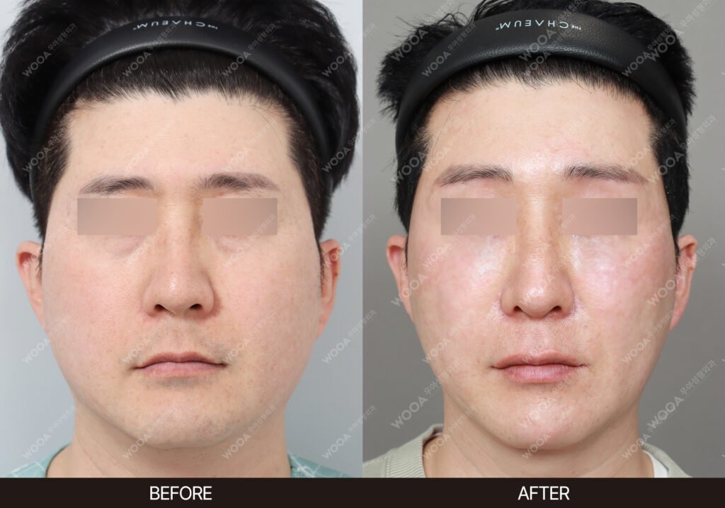 Forehead Lift before and after – Case 08 – WOOA Plastic Surgery Gangnam