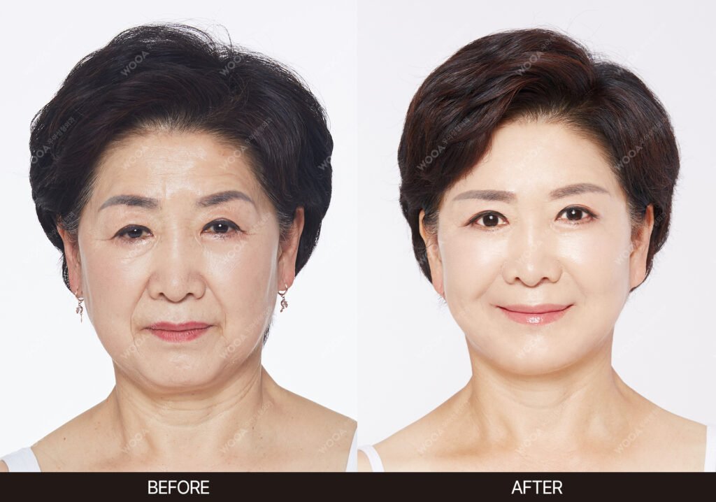 SMAS Facelift before and after – Case 10 – WOOA Plastic Surgery Gangnam