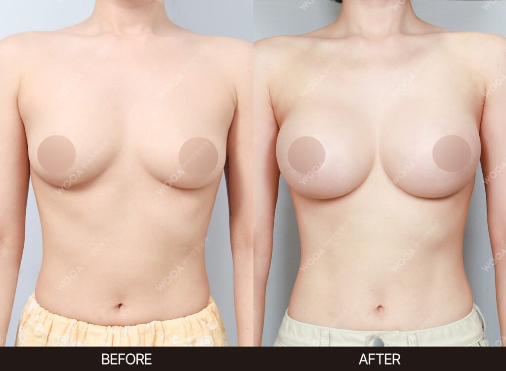 Breast Augmentation before and after – Case 26 – WOOA Plastic Surgery Gangnam