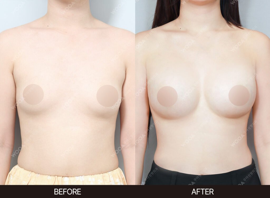 Breast Augmentation before and after – Case 21 – WOOA Plastic Surgery Gangnam