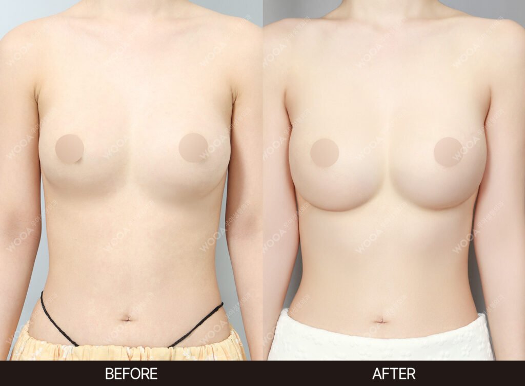 Breast Revision Surgery before and after – Case 10 – WOOA Plastic Surgery Gangnam