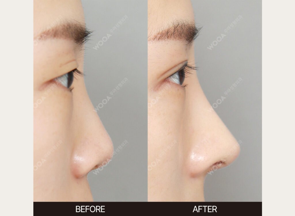 Bulbous Nose Tip Refinement before and after – Case 09 – WOOA Plastic Surgery Gangnam
