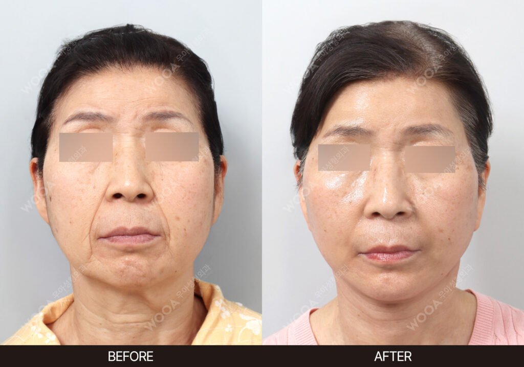 SMAS Facelift before and after – Case 05 – WOOA Plastic Surgery Gangnam