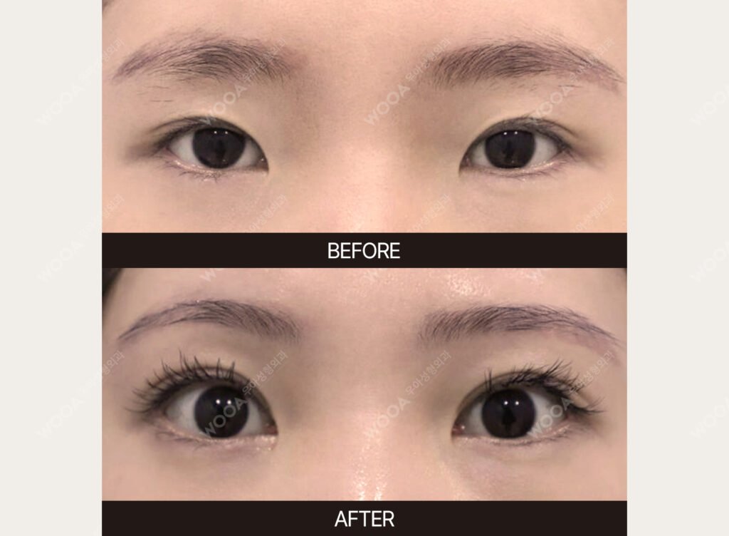 Double Eyelid Surgery before and after – Case 16 – WOOA Plastic Surgery Gangnam