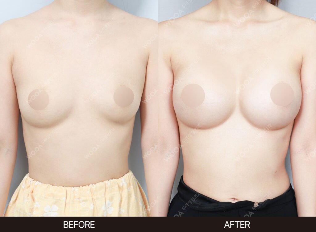 Breast Augmentation before and after – Case 24 – WOOA Plastic Surgery Gangnam