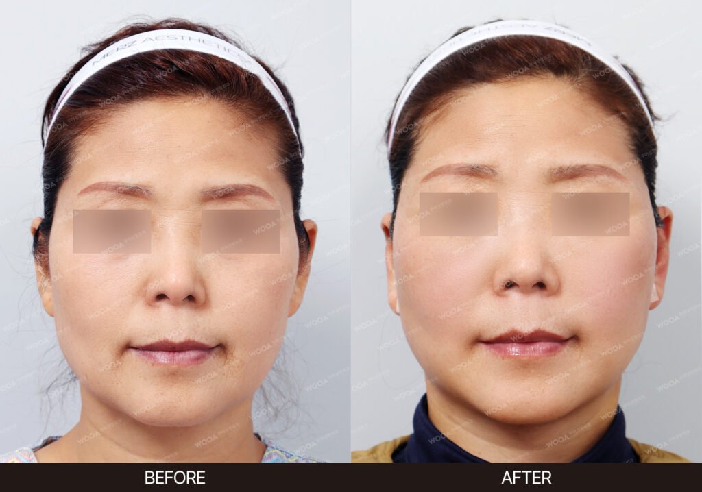 SMAS Facelift before and after – Case 03 – WOOA Plastic Surgery Gangnam
