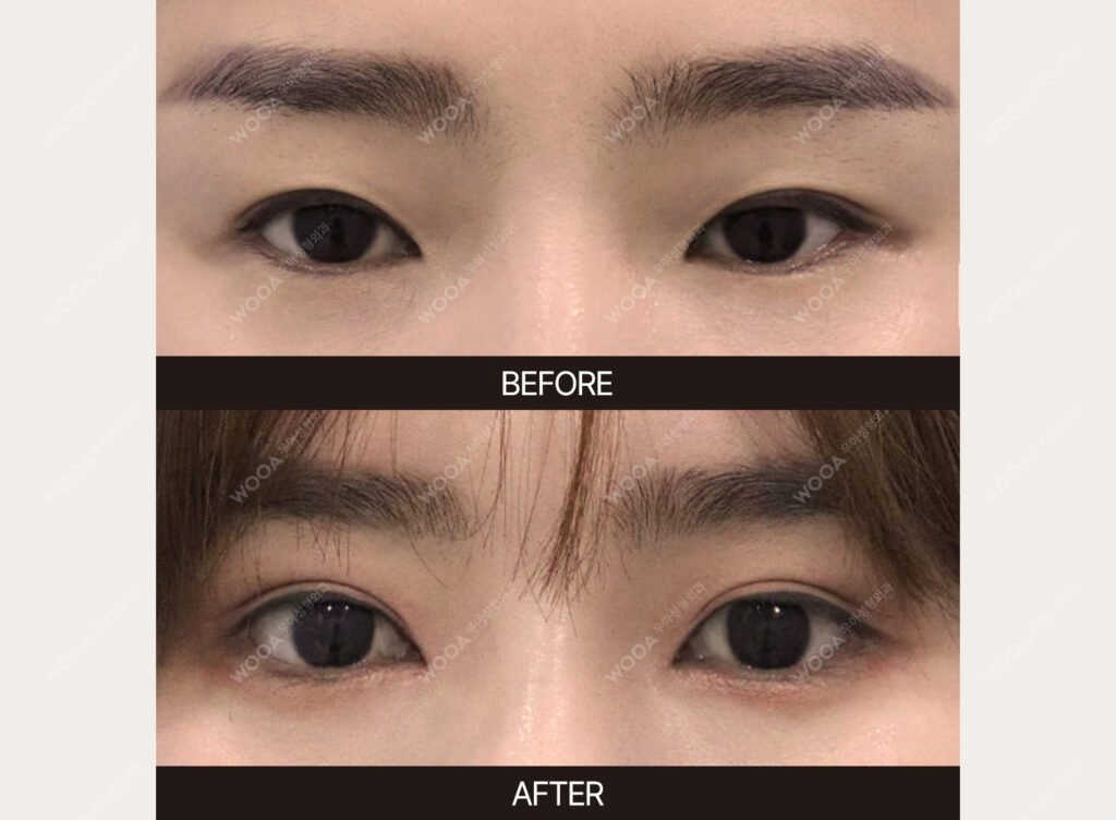 Eye Revision Surgery before and after – Case 04 – WOOA Plastic Surgery Gangnam