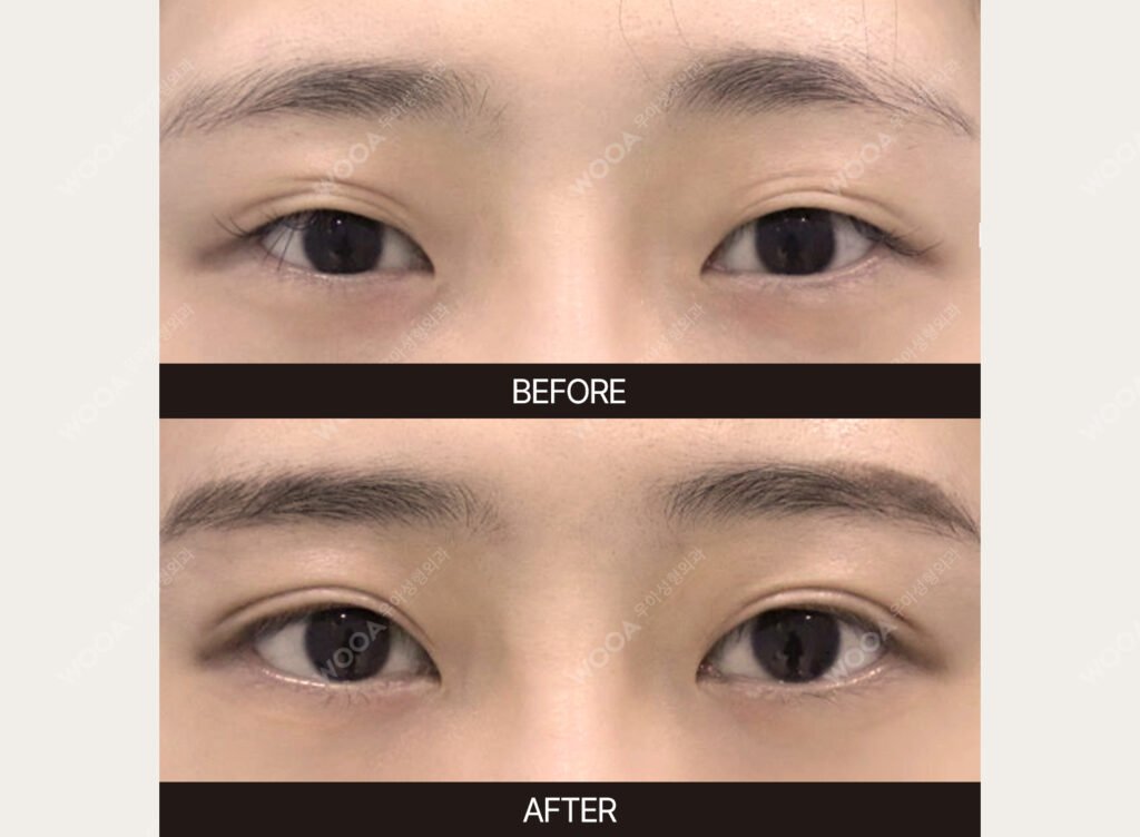 Double Eyelid Surgery before and after – Case 14 – WOOA Plastic Surgery Gangnam