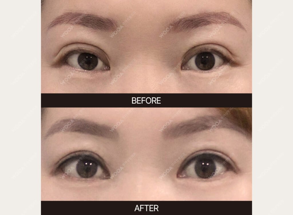 Eye Revision Surgery before and after – Case 03 – WOOA Plastic Surgery Gangnam