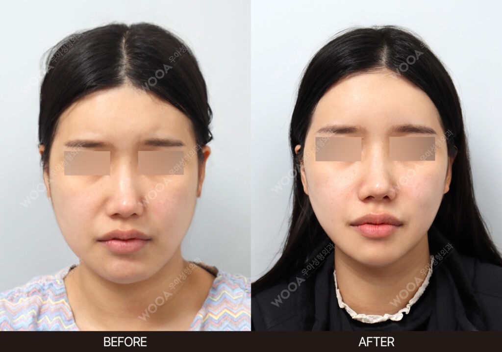 Temple Lift before and after – Case 01 – WOOA Plastic Surgery Gangnam