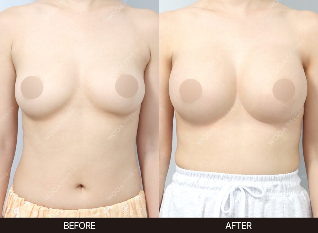 Breast Augmentation before and after – Case 05 – WOOA Plastic Surgery Gangnam