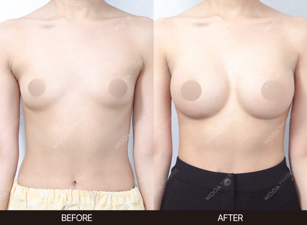 Breast Augmentation before and after – Case 03 – WOOA Plastic Surgery Gangnam