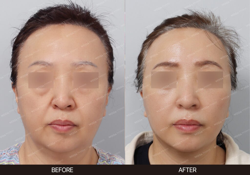SMAS Facelift before and after – Case 04 – WOOA Plastic Surgery Gangnam