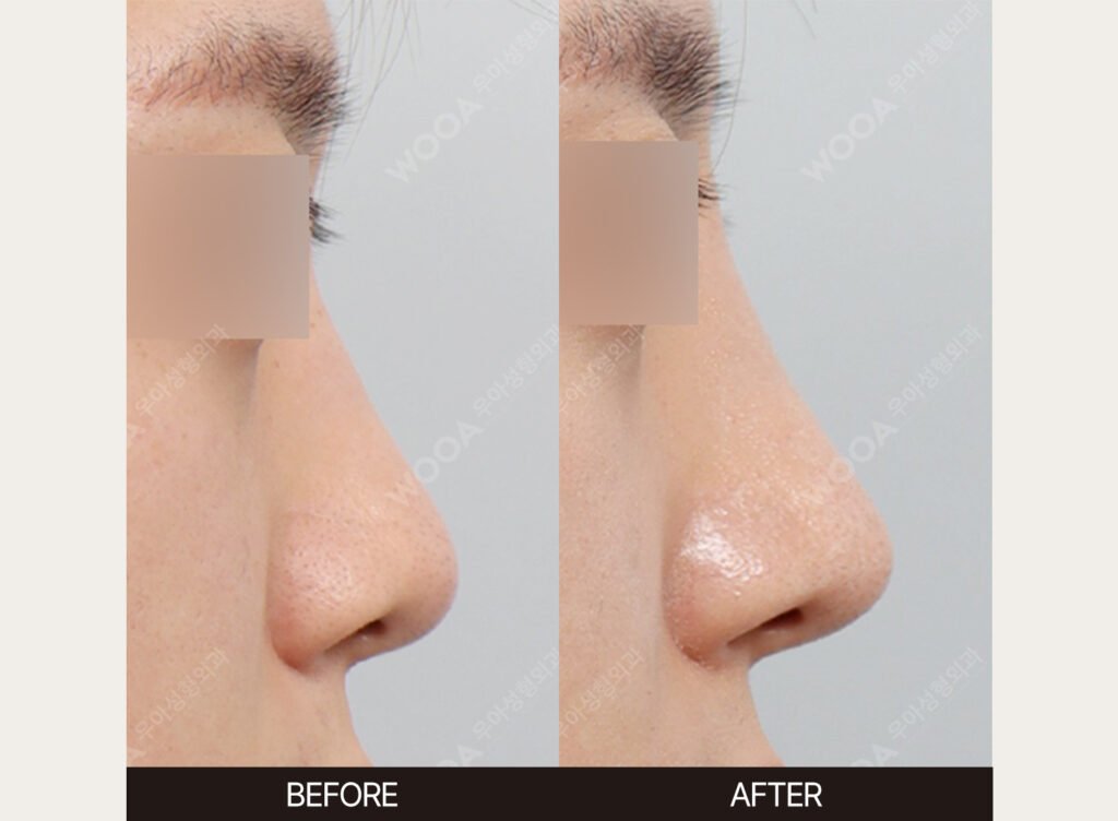 Dorsal Hump Correction before and after – Case 04 – WOOA Plastic Surgery Gangnam