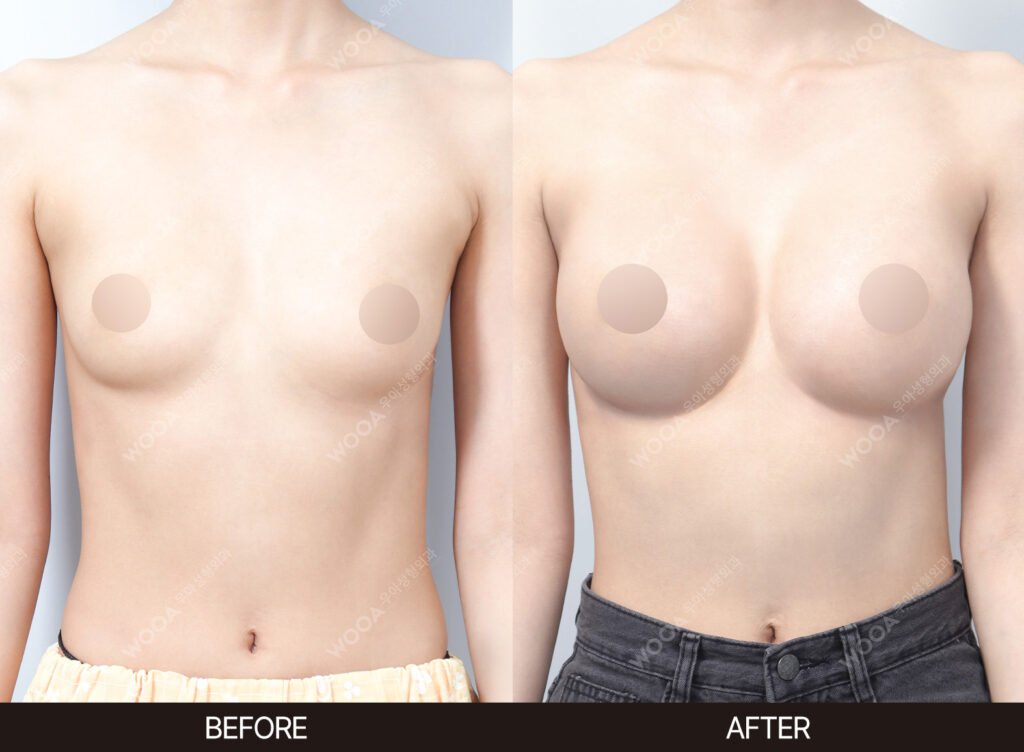 Breast Augmentation before and after – Case 08 – WOOA Plastic Surgery Gangnam