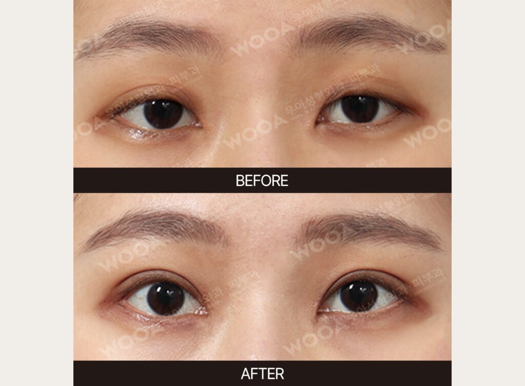 Double Eyelid Surgery before and after – Case 06 – WOOA Plastic Surgery Gangnam