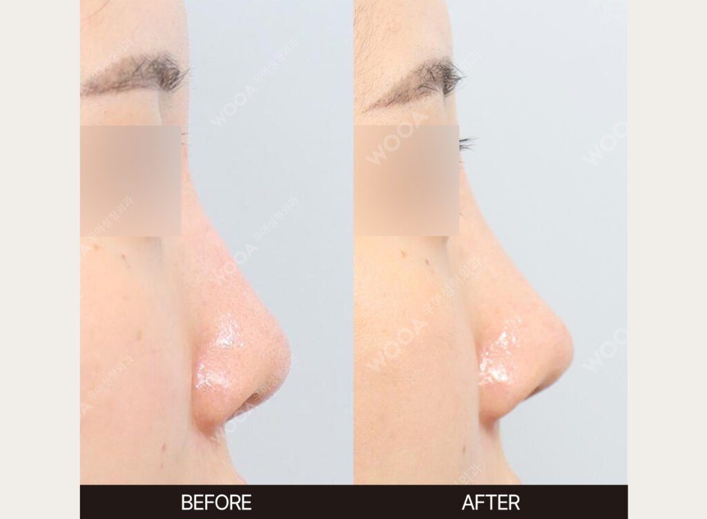 Revision Rhinoplasty before and after – Case 02 – WOOA Plastic Surgery Gangnam