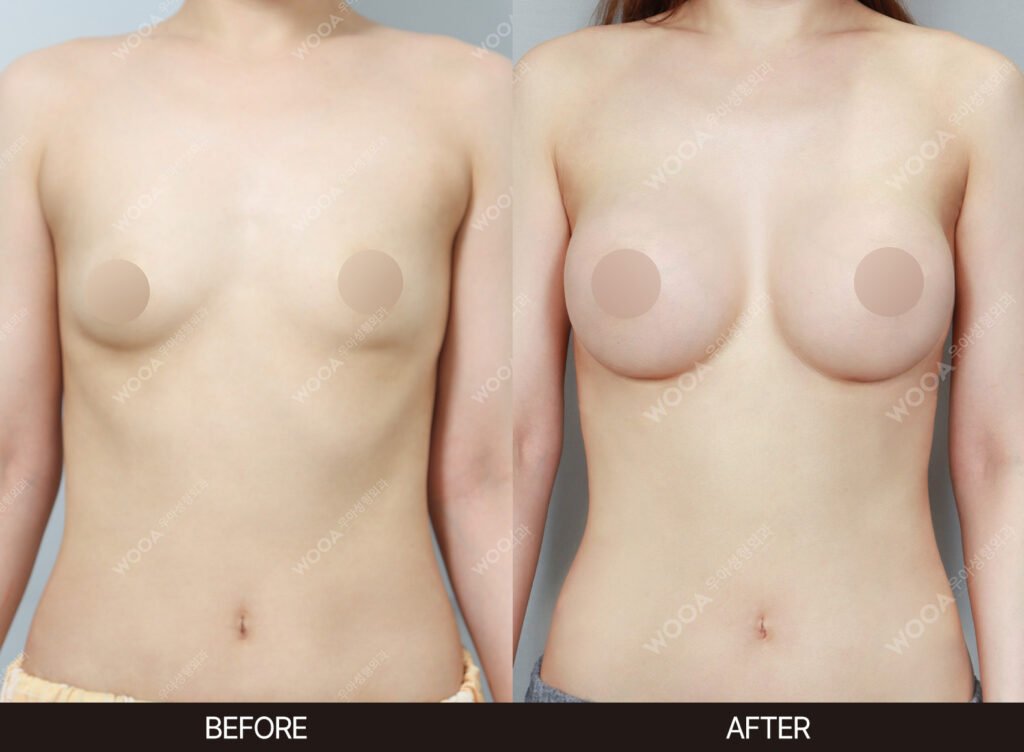 Breast Augmentation before and after – Case 31 – WOOA Plastic Surgery Gangnam