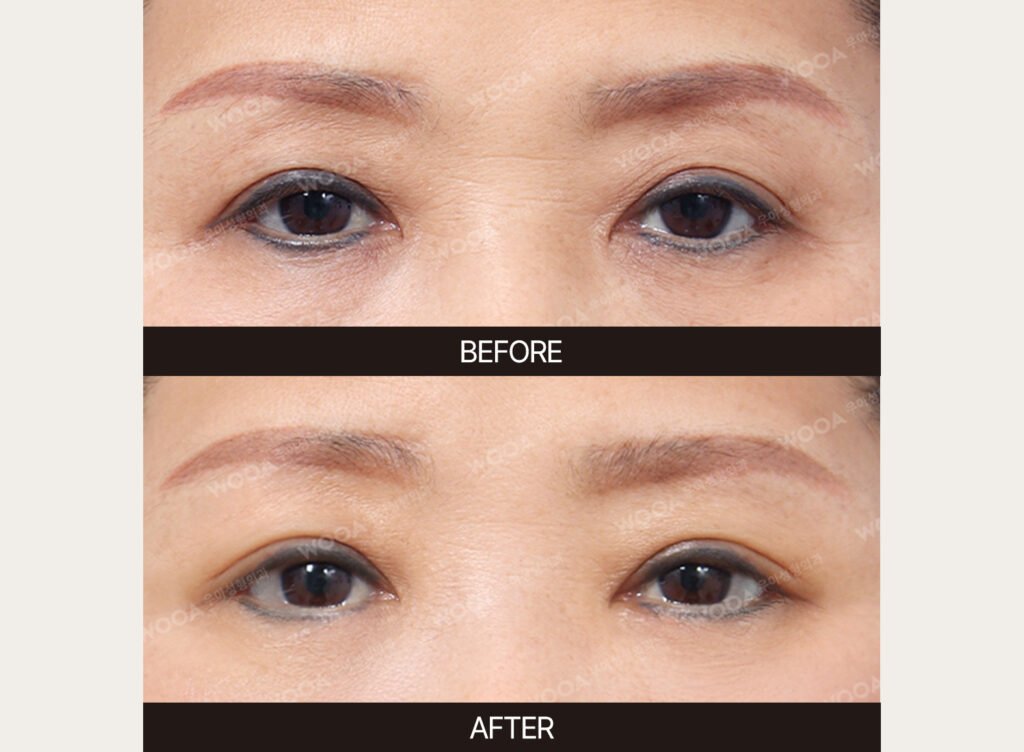 Lower Blepharoplasty before and after – Case 05 – WOOA Plastic Surgery Gangnam