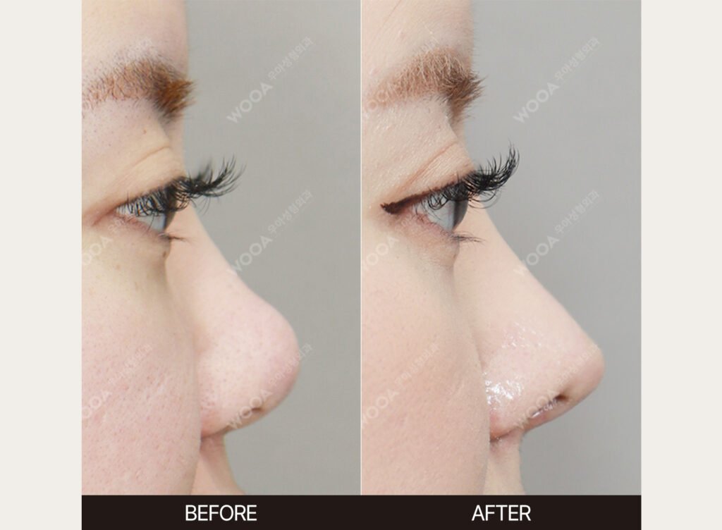 Short Nose Correction before and after – Case 02 – WOOA Plastic Surgery Gangnam