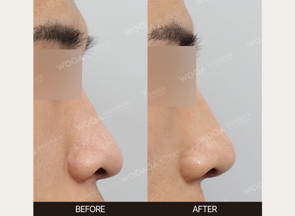 Low Nose Bridge Augmentation before and after – Case 02 – WOOA Plastic Surgery Gangnam