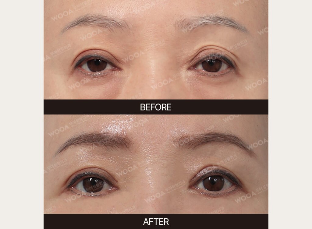 Lower Blepharoplasty before and after – Case 06 – WOOA Plastic Surgery Gangnam