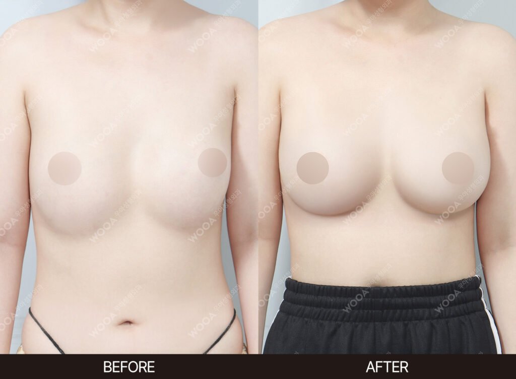 Breast Revision Surgery before and after – Case 03 – WOOA Plastic Surgery Gangnam