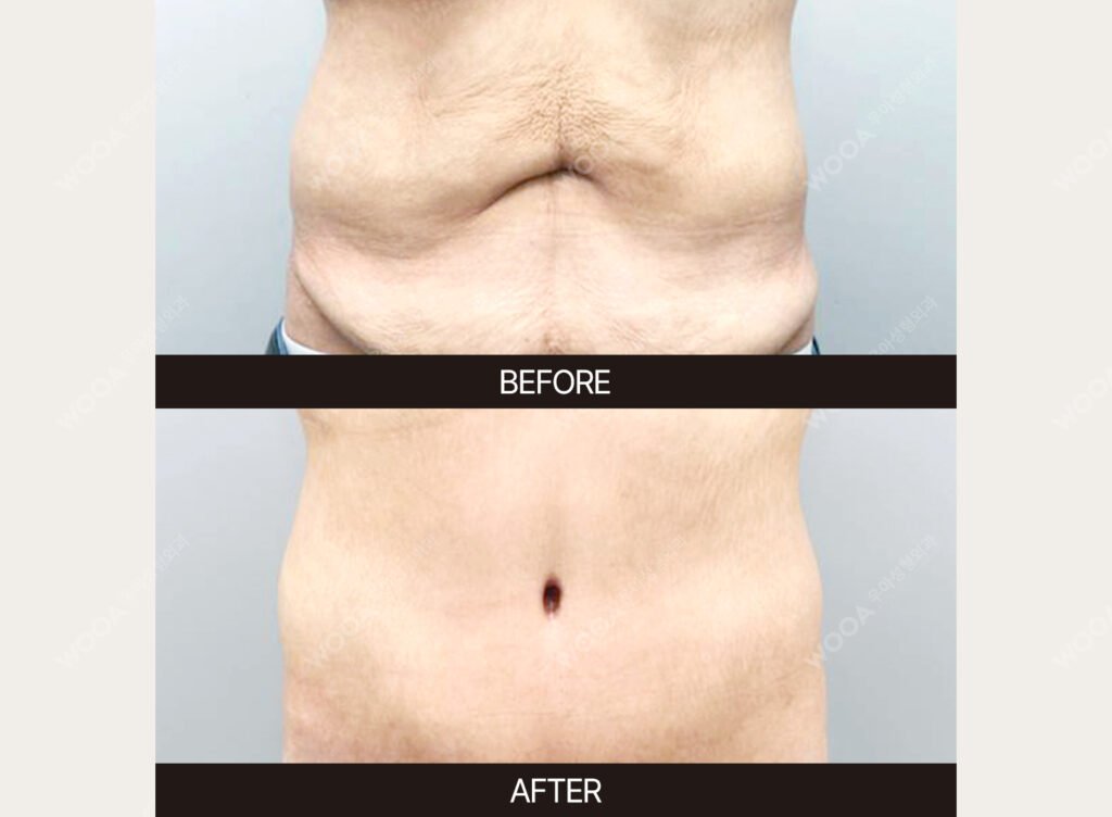 Tummy Tuck (Abdominal Body Lift) before and after – Case 08 – WOOA Plastic Surgery Gangnam