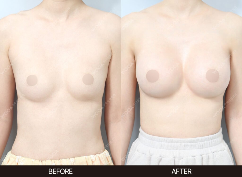 Breast Augmentation before and after – Case 14 – WOOA Plastic Surgery Gangnam