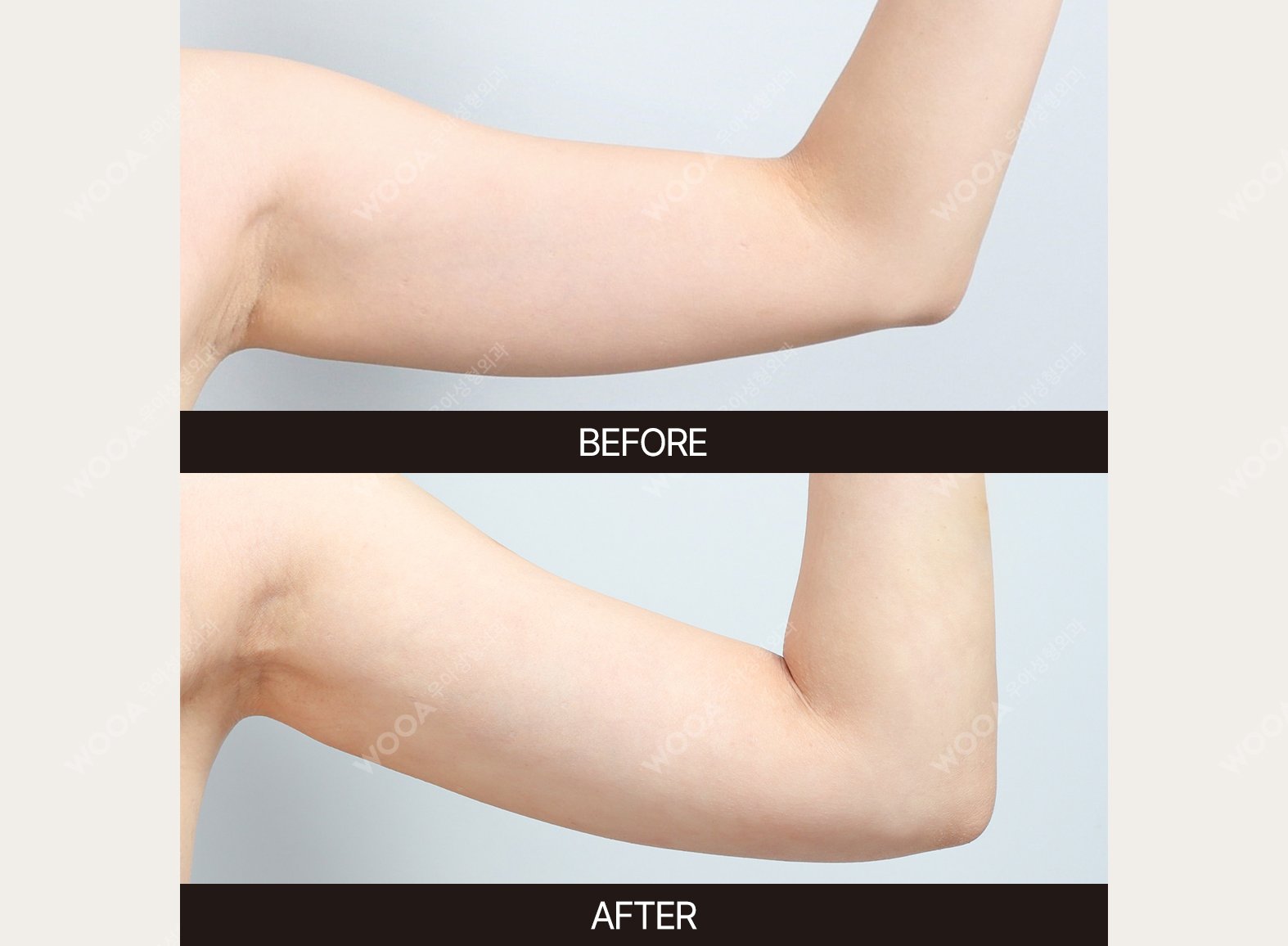 WOOA Plastic Surgery body before and after