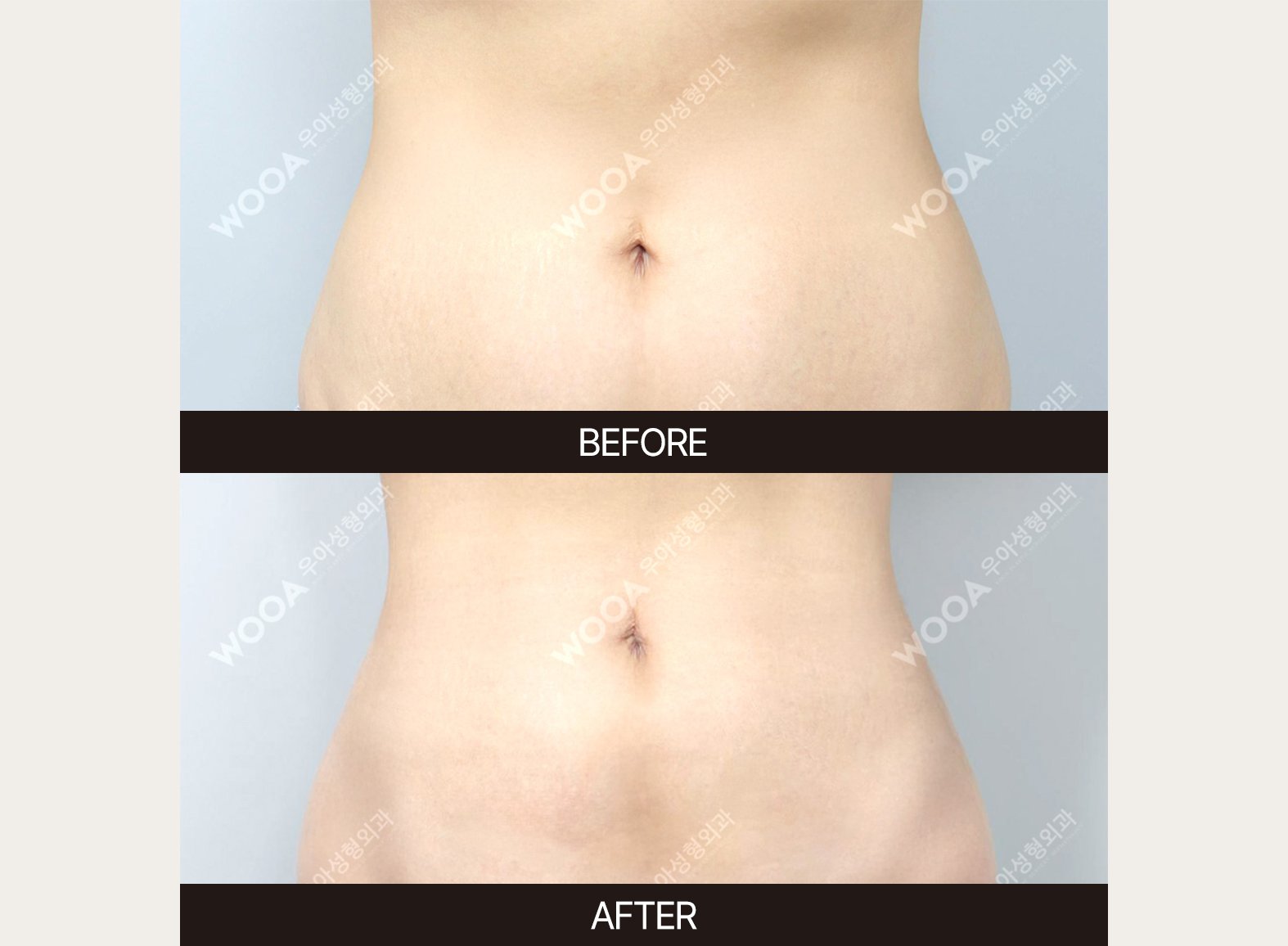 WOOA Plastic Surgery body before and after