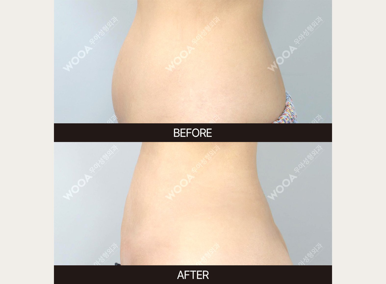 WOOA Plastic Surgery body before and after