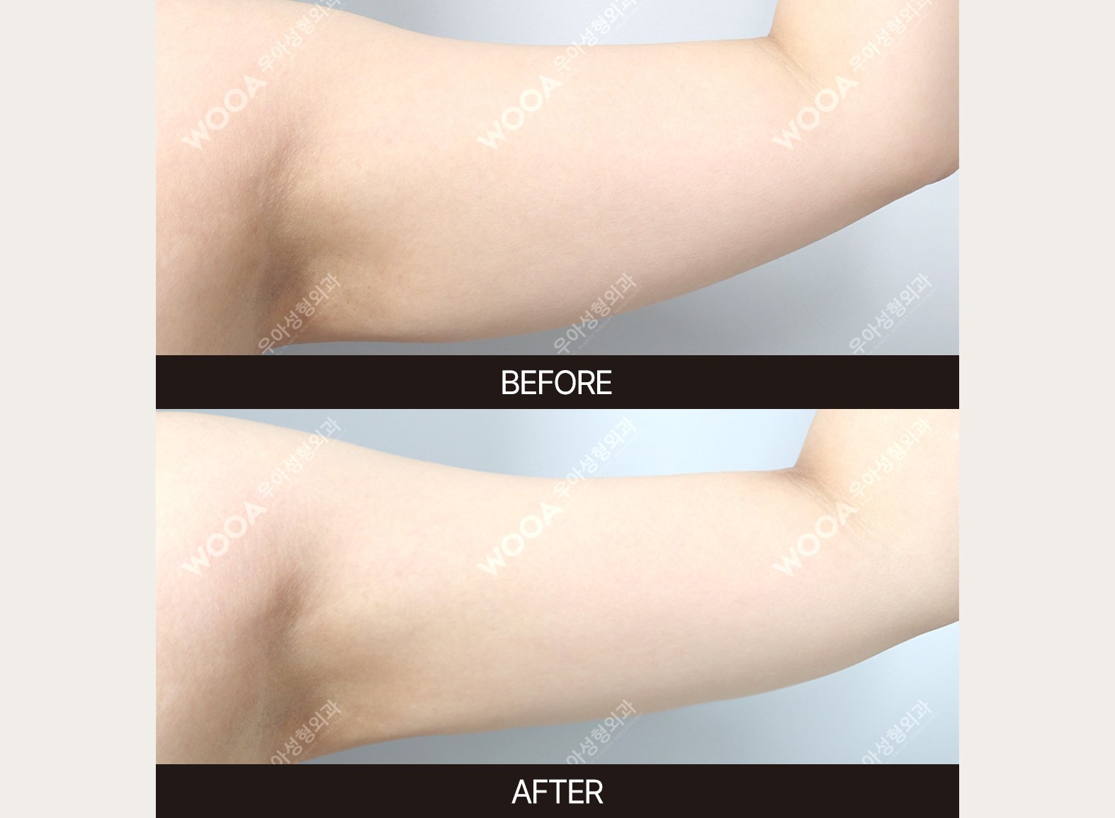 WOOA Plastic Surgery body before and after