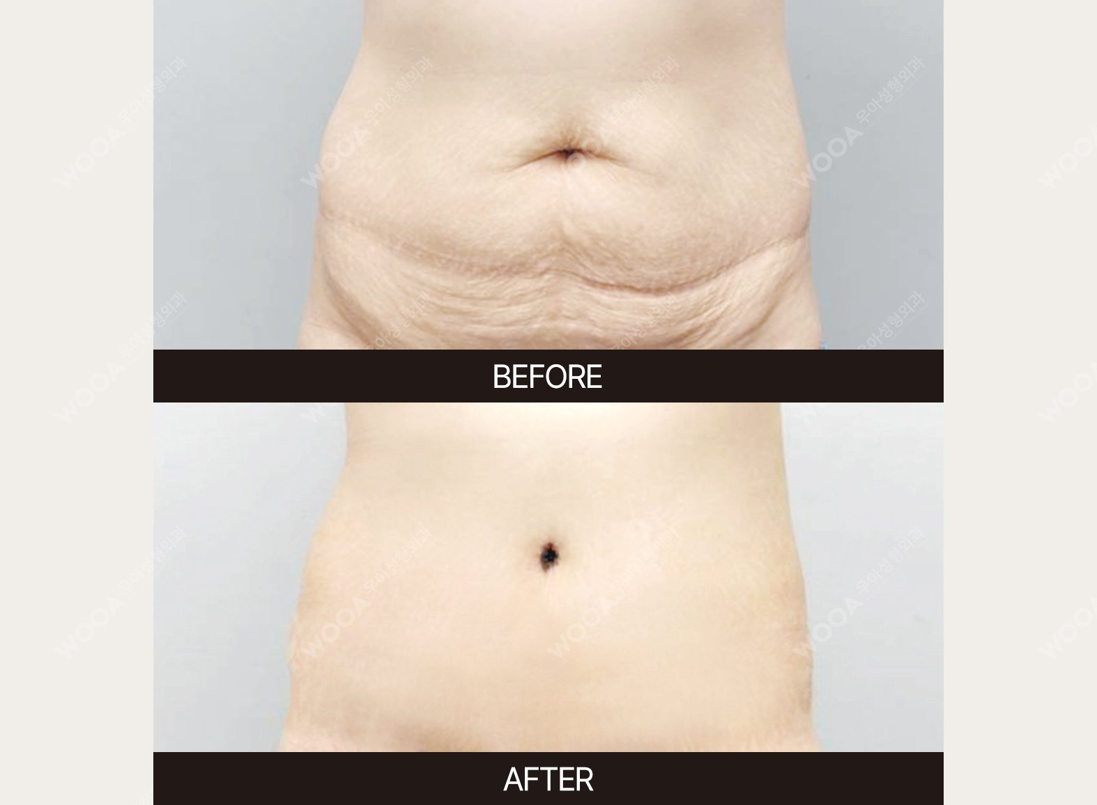 WOOA Plastic Surgery body before and after