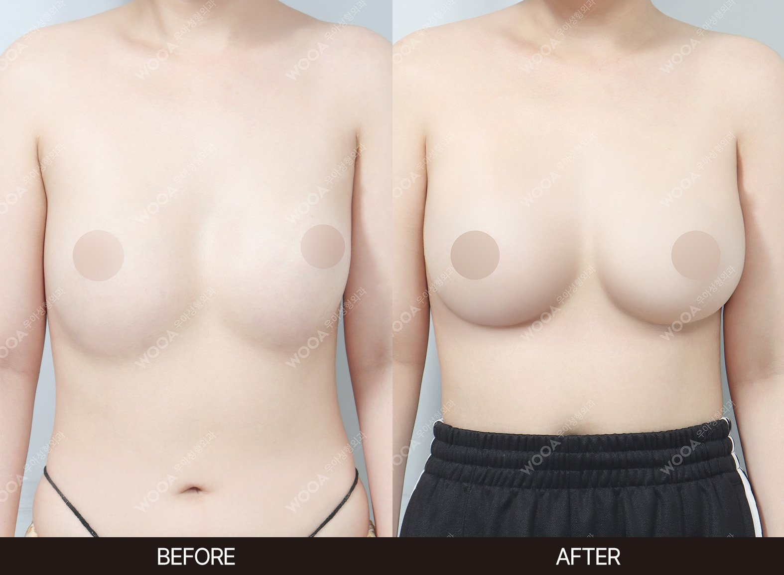 WOOA Plastic Surgery breast before and after