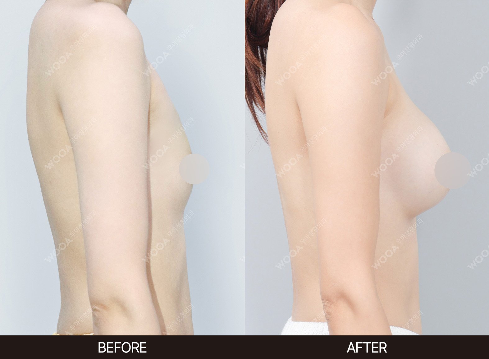 WOOA Plastic Surgery breast before and after
