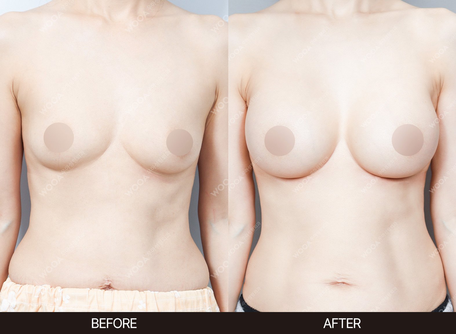 WOOA Plastic Surgery breast before and after