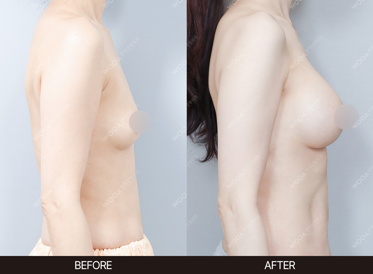 WOOA Plastic Surgery breast before and after