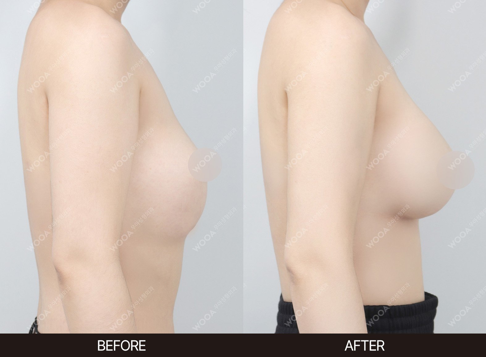 WOOA Plastic Surgery breast before and after