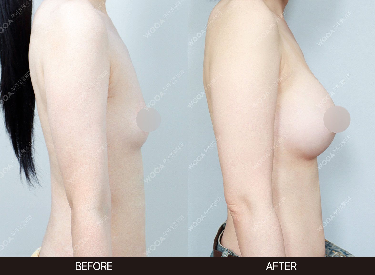 WOOA Plastic Surgery breast before and after