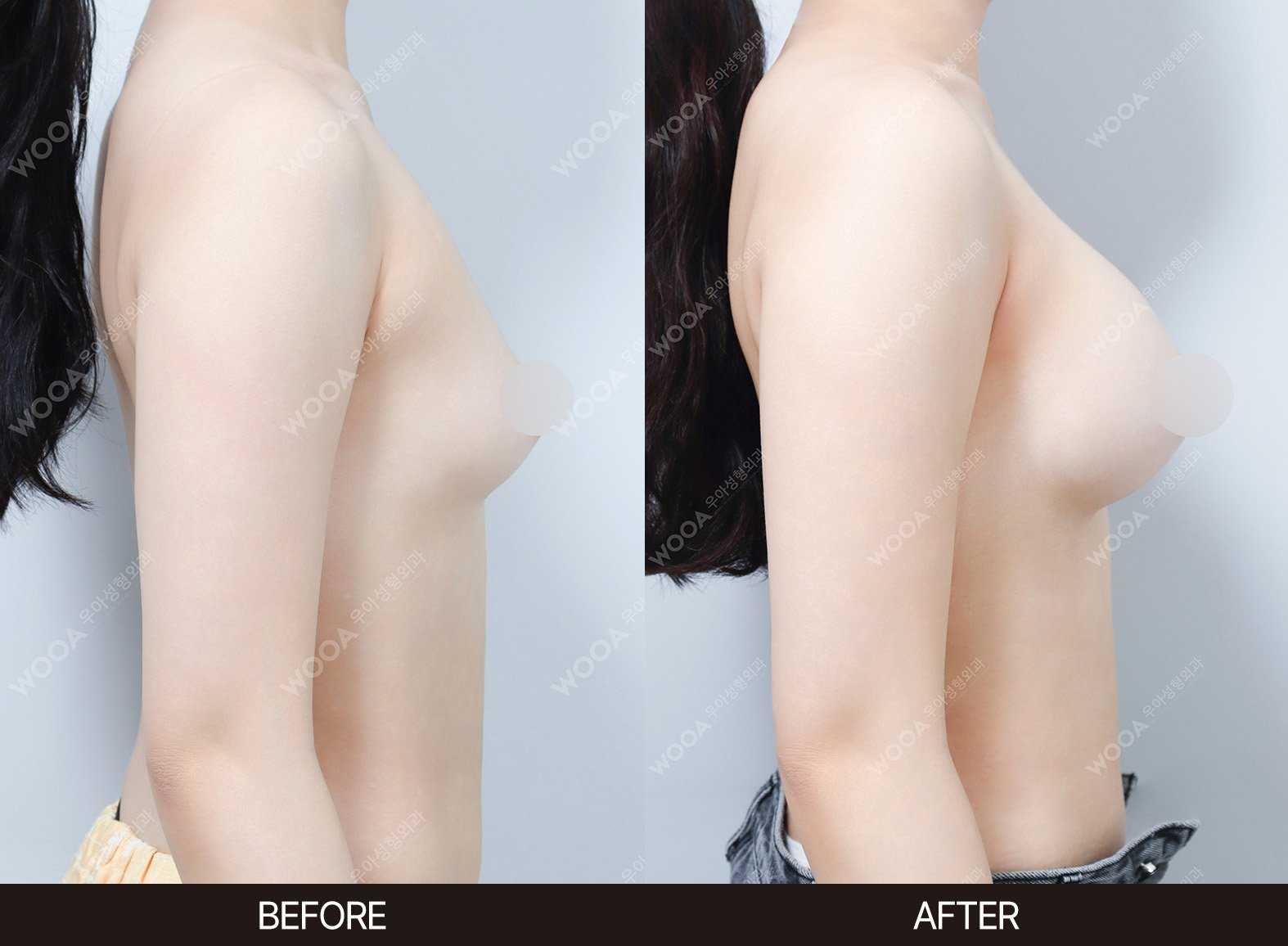 WOOA Plastic Surgery breast before and after