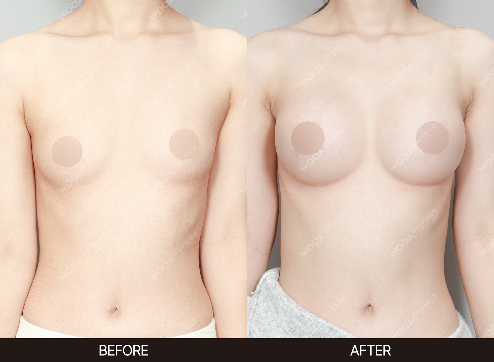 WOOA Plastic Surgery breast before and after