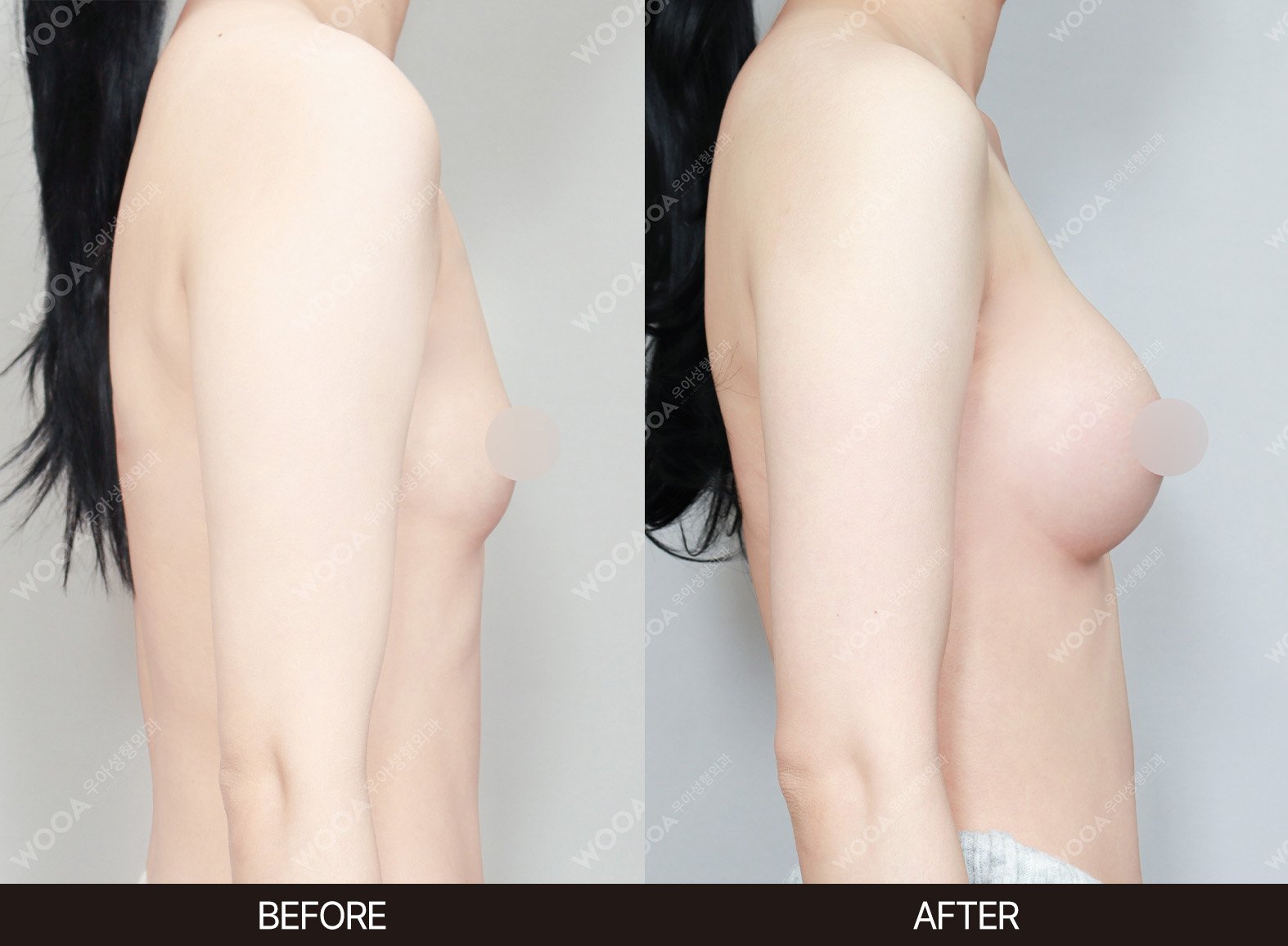 WOOA Plastic Surgery breast before and after