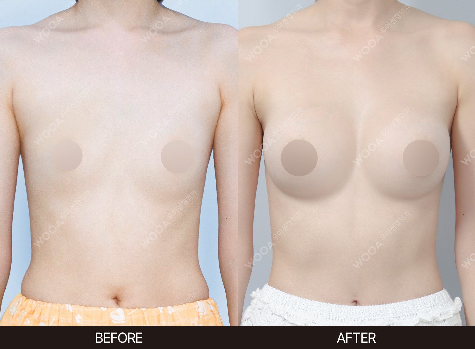 WOOA Plastic Surgery breast before and after