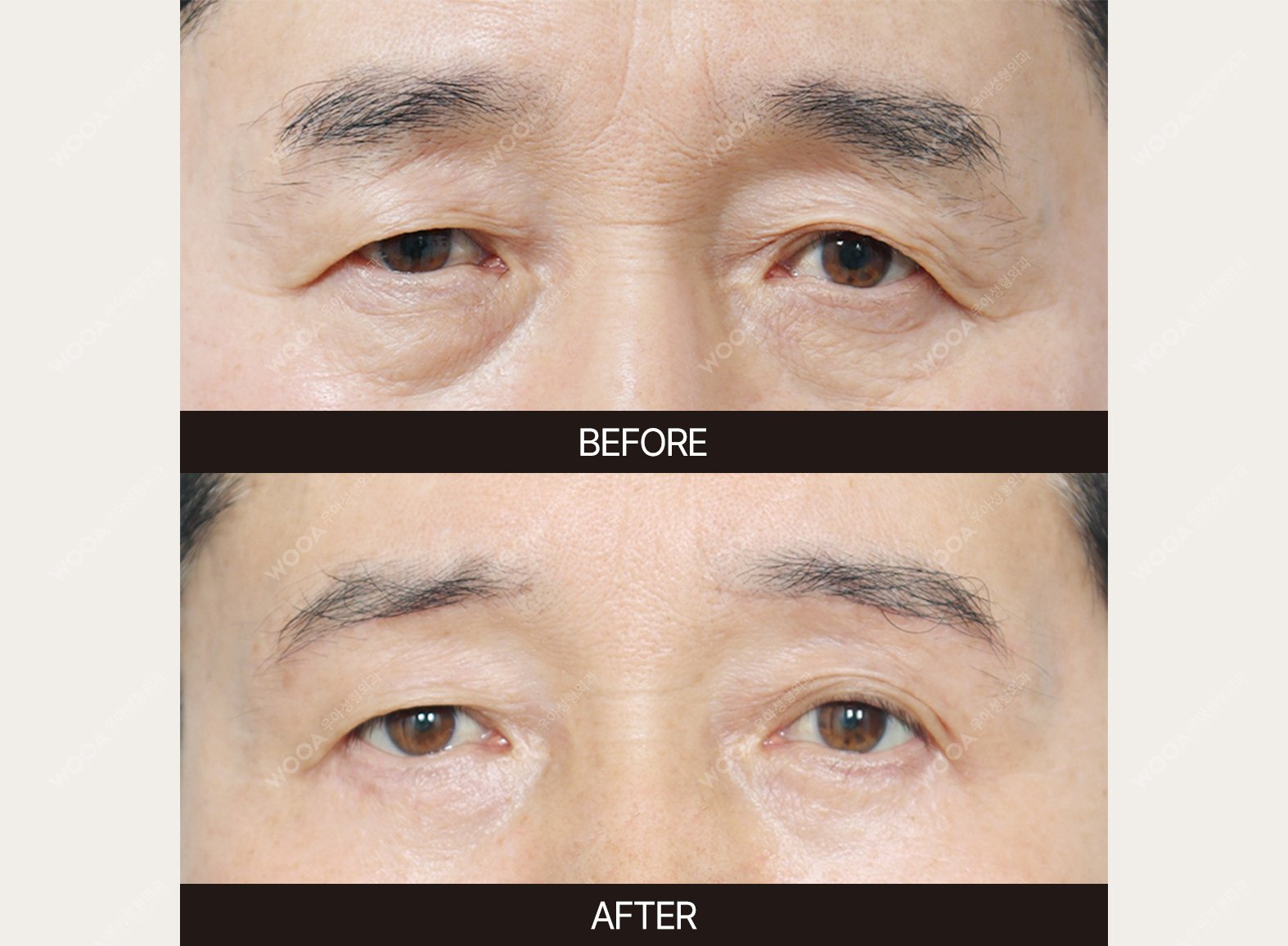 WOOA Plastic Surgery eyes before and after