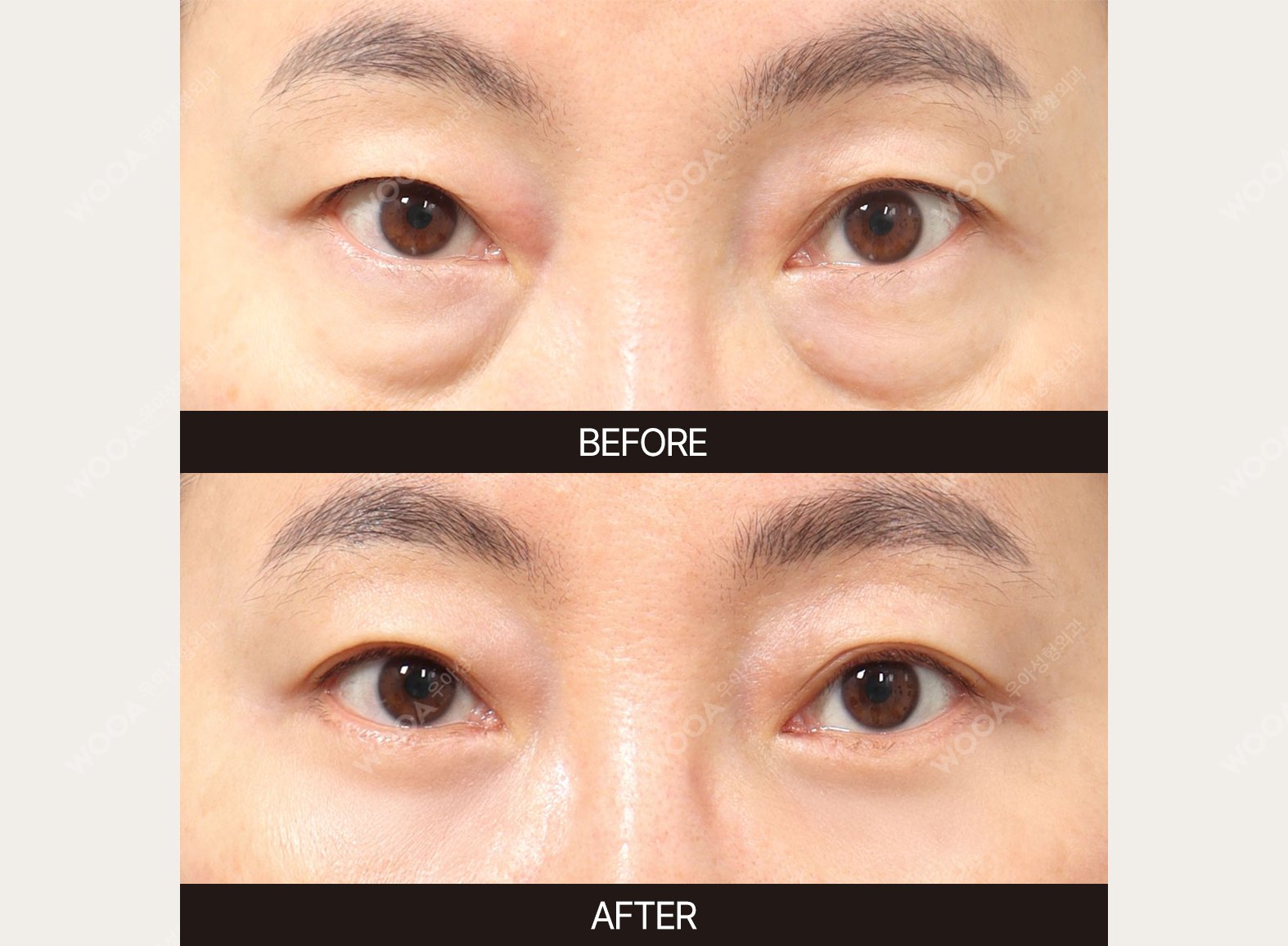 WOOA Plastic Surgery eyes before and after