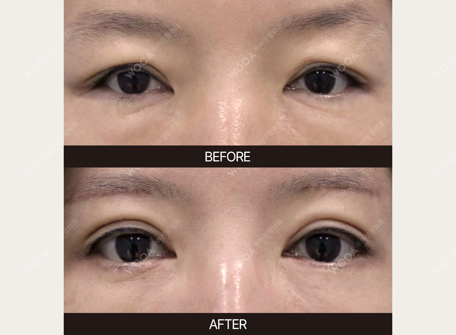 WOOA Plastic Surgery eyes before and after