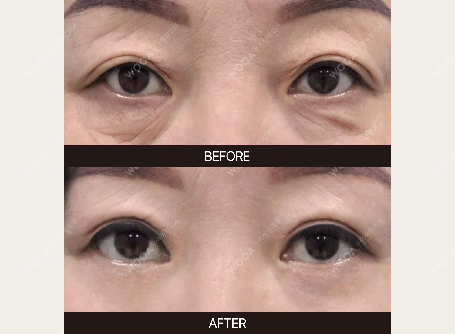 WOOA Plastic Surgery eyes before and after