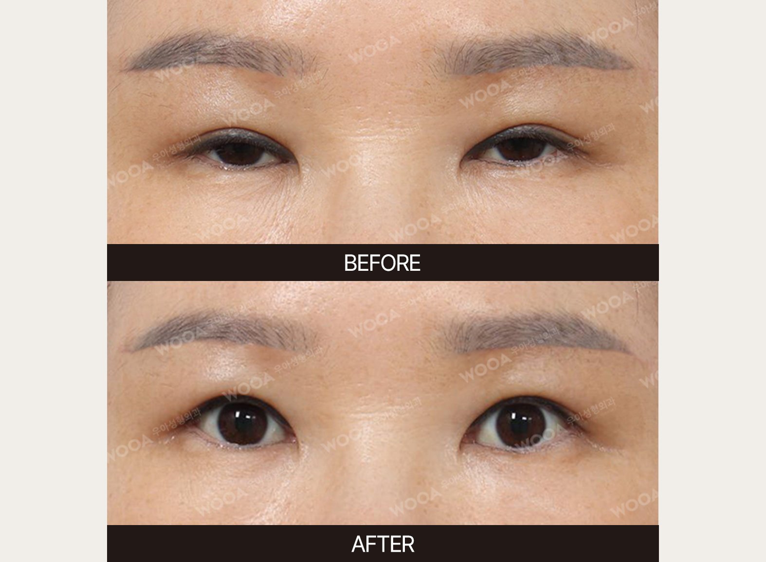 WOOA Plastic Surgery eyes before and after